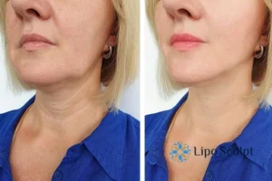 Double chin before and after Hi-Fu treatment 4 Book your double chin treatment Arnold today! We are here to help!