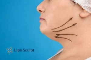 Double chin before and after Hi-Fu treatment 3 Boost your confidence with a Double chin treatment Arnold