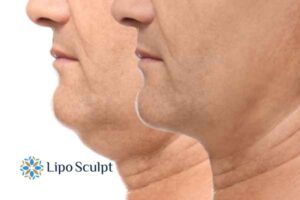 Double chin before and after Hi-Fu treatment 2 Double chin treatment Arnold from Lipo Sculpt - feel more confident today!