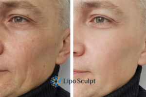 How to Fight Aging Symptoms 3 Fight Aging Symptoms Arnold With HIFU and Morpheus8 Today!