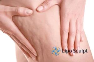 CoolSculpting for Legs: The Innovative Approach to Redefining Your Legs 5 Start your journey today book your coolsculpting treatment Arnold online today!